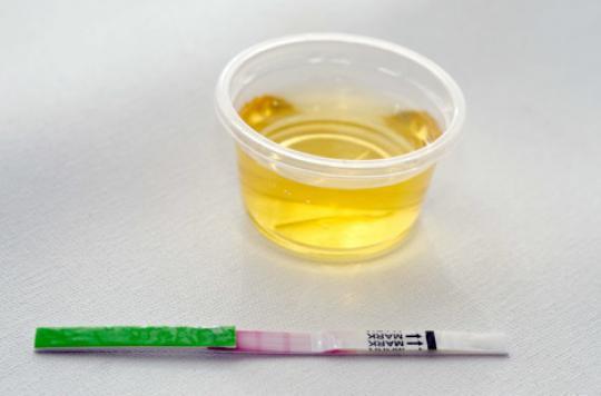 Papillomavirus : un simple test urinaire pour le dépister
